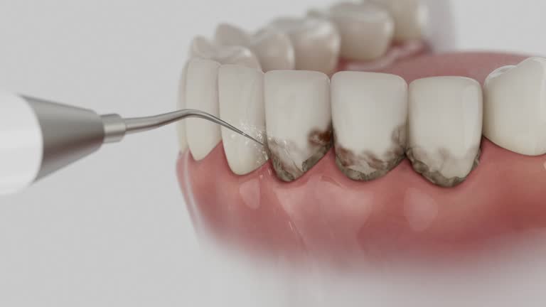 Trusted Wisdom Tooth Removal service in Irvine, CA - Dentist Open Now